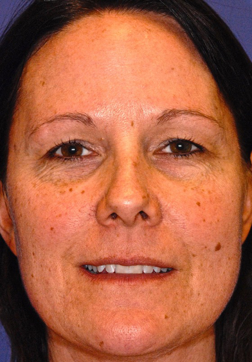 Patient 4 before photo of Active FX™ Laser Skin Tightening patient at Sensational Skin Scottsdale
