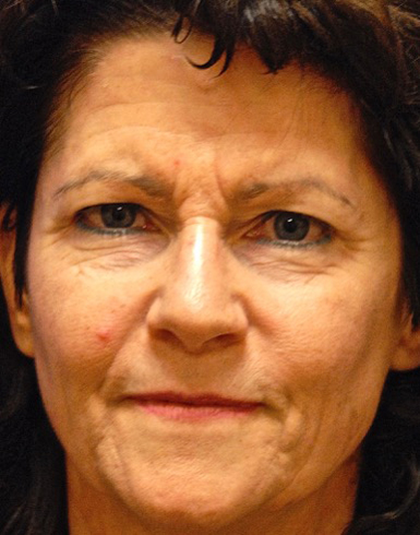 Patient 81 before photo of Face Procedures patient at Sensational Skin Scottsdale