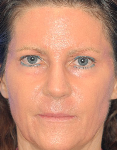 Patient 81 after photo of Face Procedures patient at Sensational Skin Scottsdale