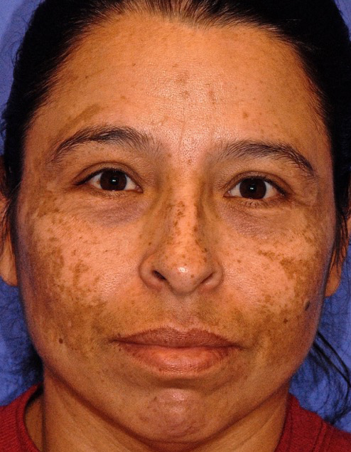 Patient 17 before photo of ZO Skin Health patient at Sensational Skin Scottsdale