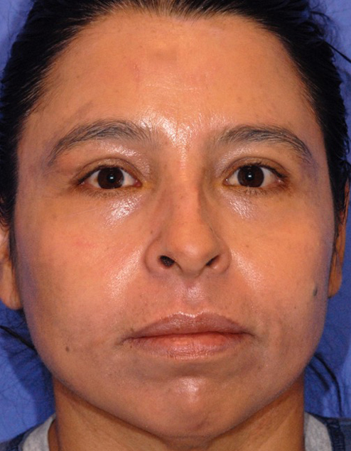 Patient 17 after photo of ZO Skin Health patient at Sensational Skin Scottsdale