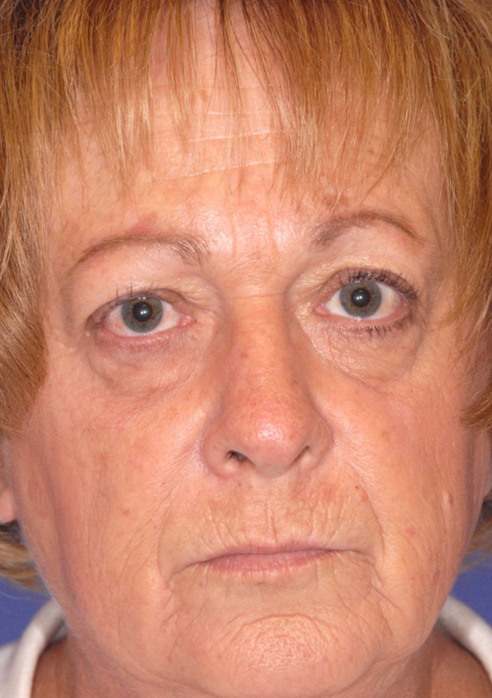 Patient 74 before photo of Face Procedures patient at Sensational Skin Scottsdale