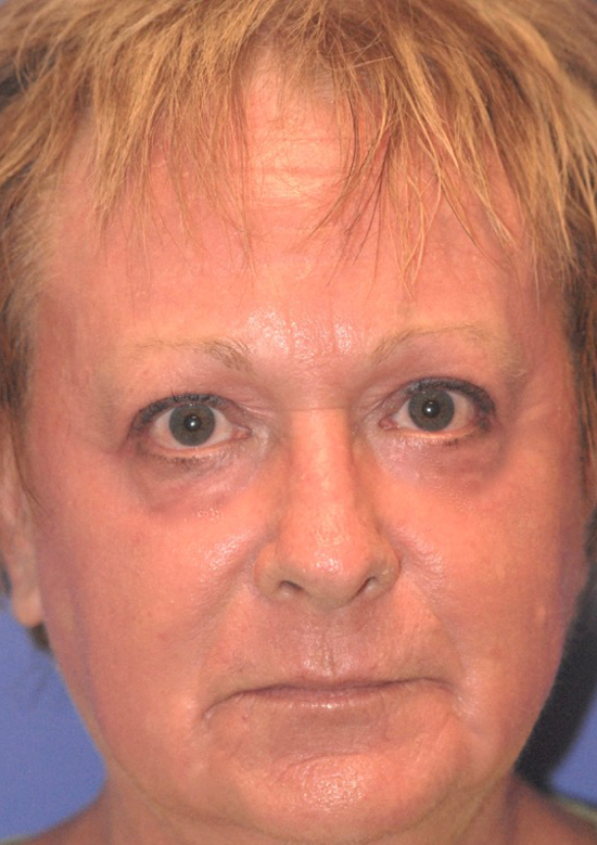Patient 74 after photo of Face Procedures patient at Sensational Skin Scottsdale