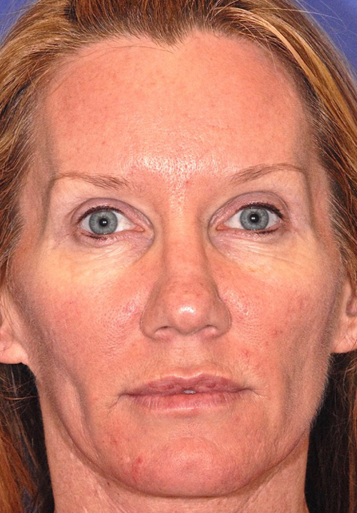 Patient 68 before photo of Face Procedures patient at Sensational Skin Scottsdale