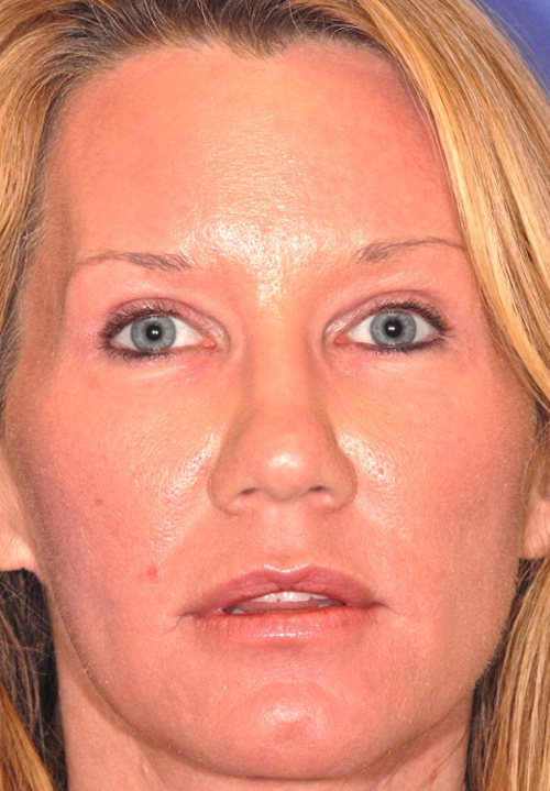 Patient 68 after photo of Face Procedures patient at Sensational Skin Scottsdale