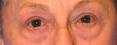 Patient 11 after photo of Laser EyeLid Lift patient at Sensational Skin Scottsdale