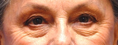 Patient 11 before photo of Laser EyeLid Lift patient at Sensational Skin Scottsdale