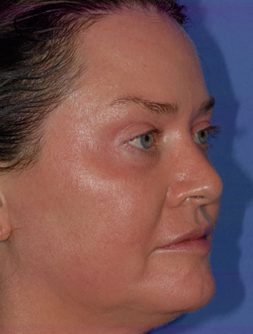 Patient 16 after photo of Laser EyeLid Lift patient at Sensational Skin Scottsdale