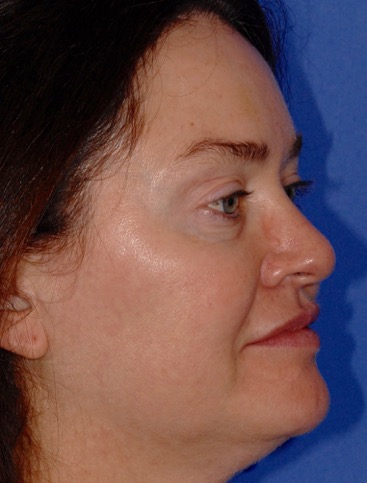 Patient 16 before photo of Laser EyeLid Lift patient at Sensational Skin Scottsdale