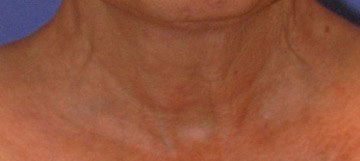 Patient 4 after photo of Ultherapy patient at Sensational Skin Scottsdale