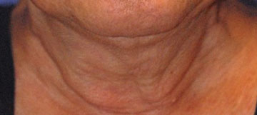 Patient 4 before photo of Ultherapy patient at Sensational Skin Scottsdale