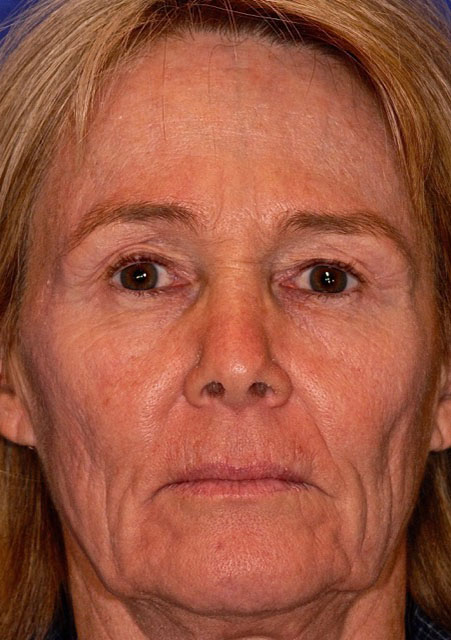 Patient 28 before photo of ZO Skin Health patient at Sensational Skin Scottsdale