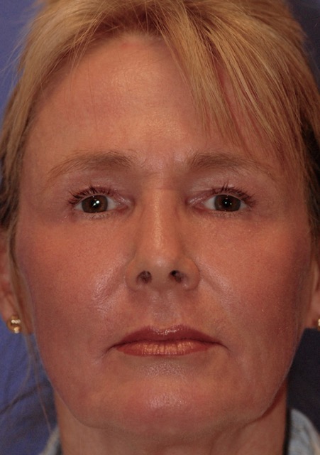 Patient 28 after photo of ZO Skin Health patient at Sensational Skin Scottsdale