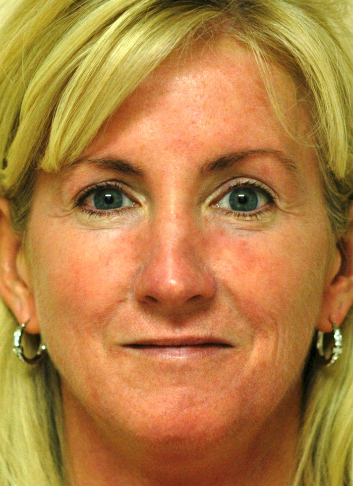 Rosacea & Skin Inflammation Treatment in Scottsdale