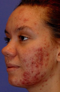 Patient 13 before photo of Acne Scars patient at Sensational Skin Scottsdale