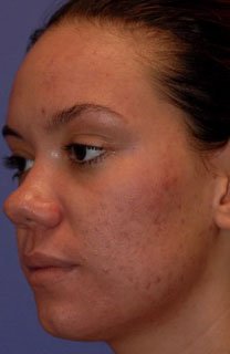 Patient 13 after photo of Acne Scars patient at Sensational Skin Scottsdale