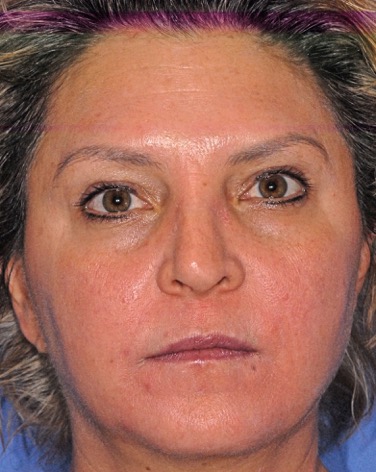 After Obagi Systems patient