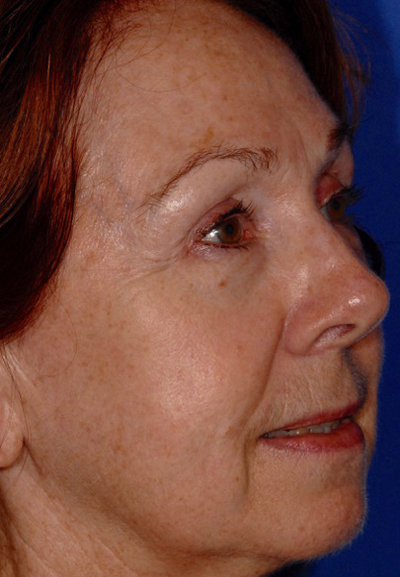 Before Photo Facial patient