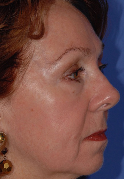 After Photo Facial patient