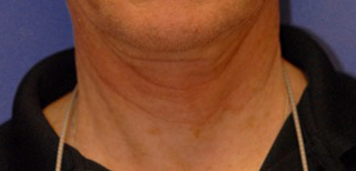 Patient 2 before photo of Ultherapy patient at Sensational Skin Scottsdale