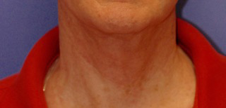 Patient 2 after photo of Ultherapy patient at Sensational Skin Scottsdale