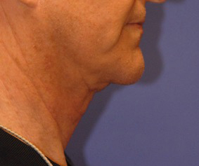 Patient 2 before photo of Ultherapy patient at Sensational Skin Scottsdale