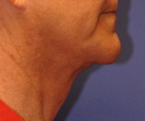 Patient 2 after photo of Ultherapy patient at Sensational Skin Scottsdale