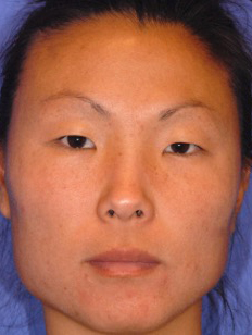 After Obagi Systems patient