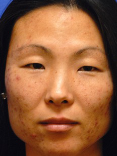Before Obagi Systems patient