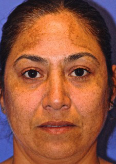 Patient 2 before photo of Melasma patient at Sensational Skin Scottsdale