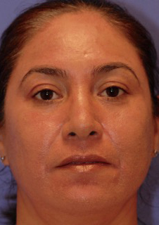 Patient 2 after photo of Melasma patient at Sensational Skin Scottsdale