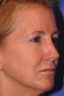 Patient 5 before photo of Laser EyeLid Lift patient at Sensational Skin Scottsdale