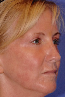 Patient 5 after photo of Laser EyeLid Lift patient at Sensational Skin Scottsdale