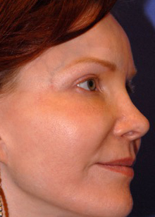 Patient 3 after photo of Laser EyeLid Lift patient at Sensational Skin Scottsdale