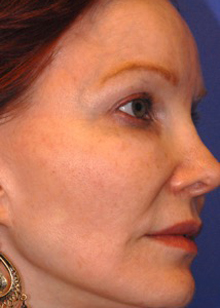 Patient 3 before photo of Laser EyeLid Lift patient at Sensational Skin Scottsdale