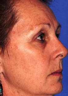 Patient 4 before photo of ZO Medical patient at Sensational Skin Scottsdale