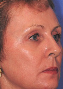 Patient 4 after photo of ZO Medical patient at Sensational Skin Scottsdale