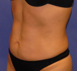 Patient 13 after photo of Coolsculpting patient at Sensational Skin Scottsdale
