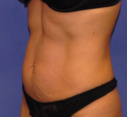 Patient 13 before photo of Coolsculpting patient at Sensational Skin Scottsdale