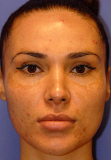 Patient 12 before photo of Acne Scars patient at Sensational Skin Scottsdale
