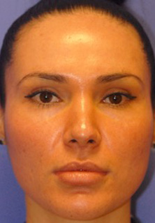 Patient 12 after photo of Acne Scars patient at Sensational Skin Scottsdale