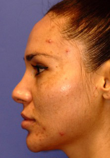 Patient 12 before photo of Acne Scars patient at Sensational Skin Scottsdale