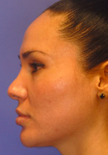 Patient 12 after photo of Acne Scars patient at Sensational Skin Scottsdale