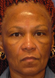 Patient 5 before photo of Acne Scars patient at Sensational Skin Scottsdale