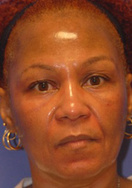 Patient 5 after photo of Acne Scars patient at Sensational Skin Scottsdale