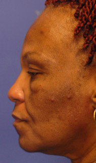 Patient 5 before photo of Acne Scars patient at Sensational Skin Scottsdale