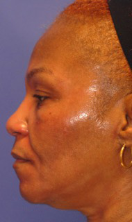 Patient 5 after photo of Acne Scars patient at Sensational Skin Scottsdale