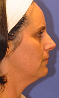 Patient 1 before photo of Ultherapy patient at Sensational Skin Scottsdale