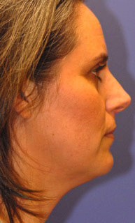 Patient 1 after photo of Ultherapy patient at Sensational Skin Scottsdale