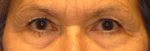 Patient 2 before photo of Laser EyeLid Lift patient at Sensational Skin Scottsdale